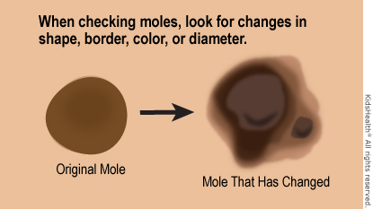 What Is Melanoma?